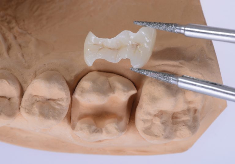 Dental Onlay-Inlay